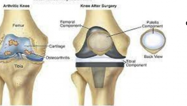 تكلفة عملية منظار غضروف الركبة في الهند
